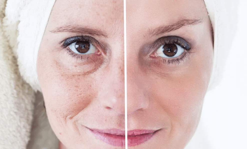 veido atjauninimas lazeriu